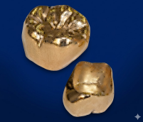 プラチナゴールド前装冠