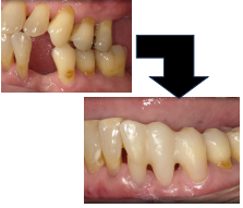 ダイレクトブリッジ