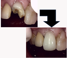 ダイレクトクラウン