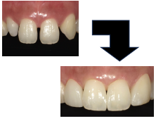 ダイレクトベニア