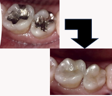 ダイレクトインレー